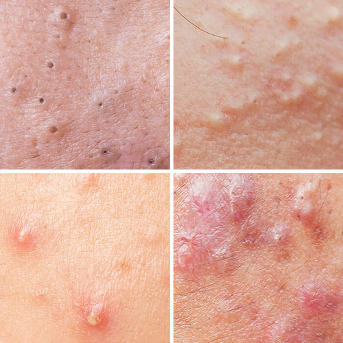 Acne blackheads, whiteheads, papules and pustules