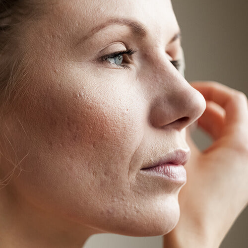A woman looking at her aging skin with acne