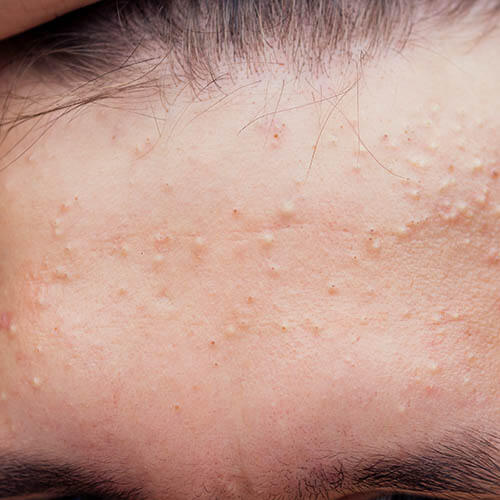 A man with blackheads and whiteheads that can become inflammatory acne