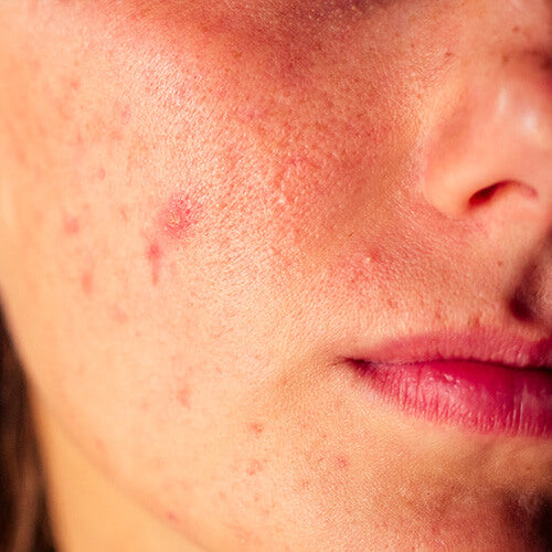 A woman with acne and sensitive skin