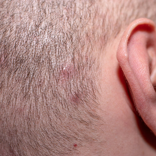 A man with scalp acne that can be treated with salicylic acid