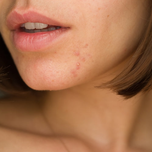 A young woman with pimples that may be teen or adult acne