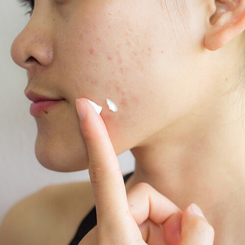 Woman applying acne spot treatment to inflammatory pimples