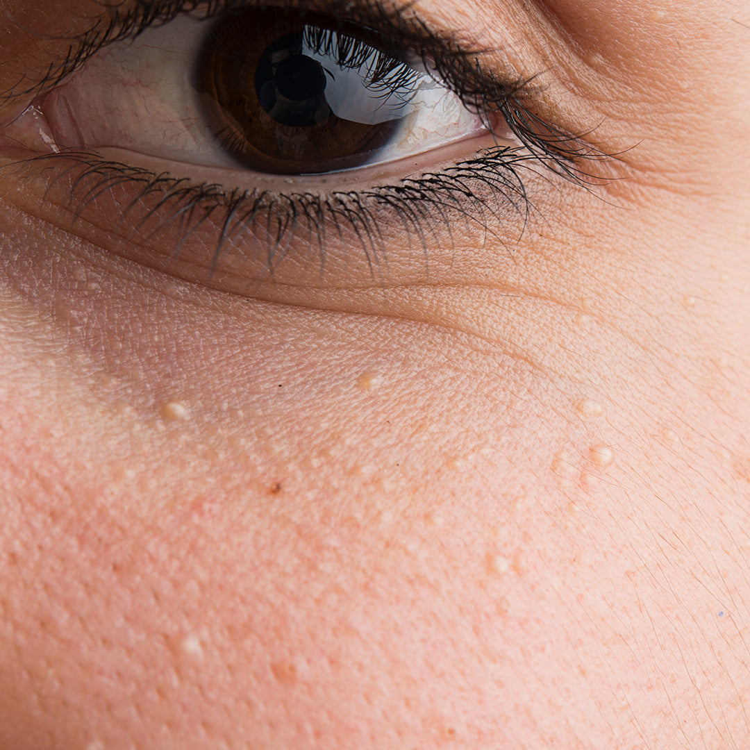 Tiny White Bumps That Won't Pop?