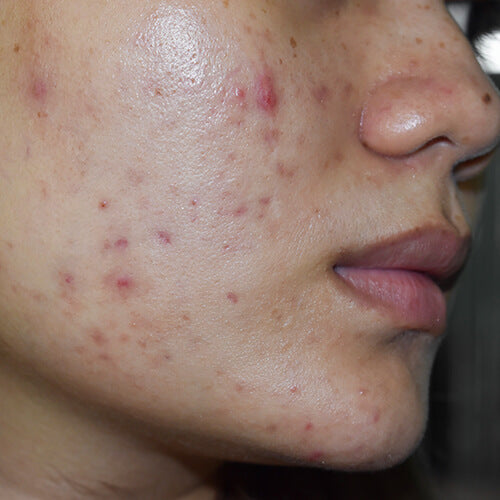 A woman with post-inflammatory erythema from acne lesions