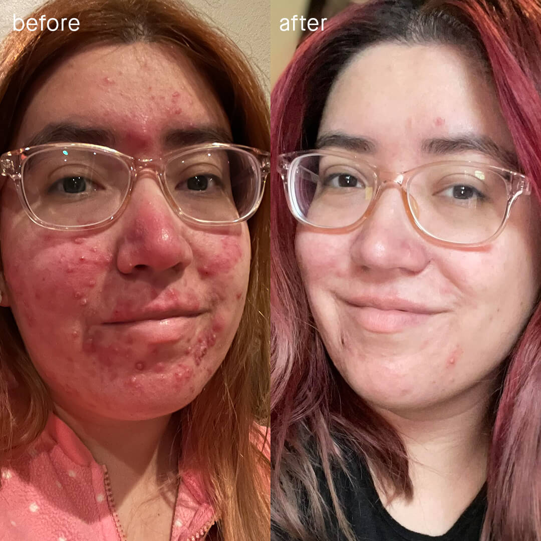 Before and after image of SLMD Acne System user Susana showing acne clearing up