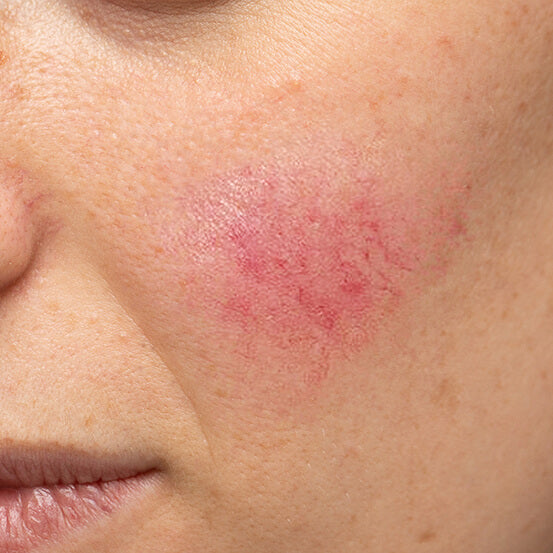 A woman with redness from rosacea