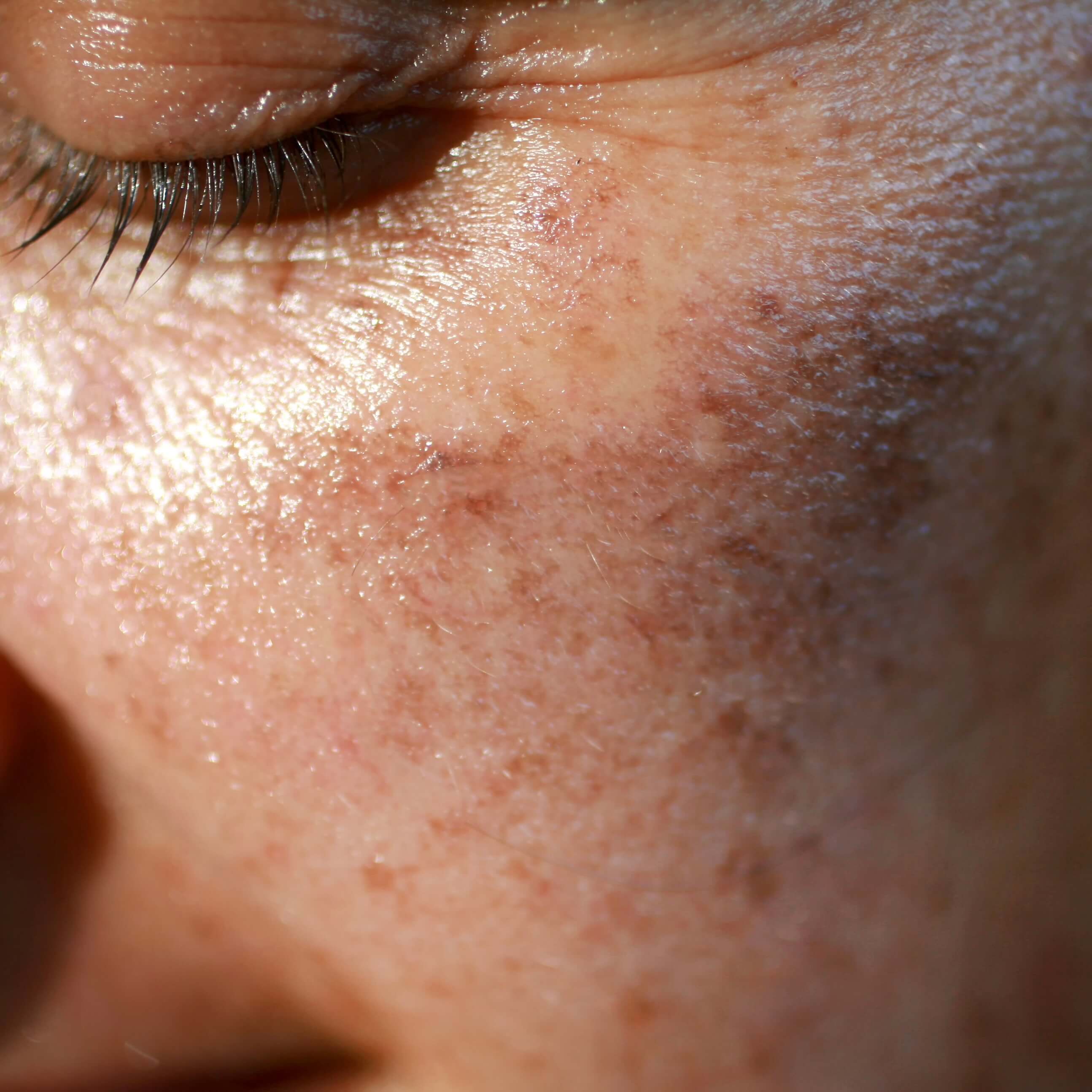 A woman with hyperpigmentation and wrinkles signs of aging