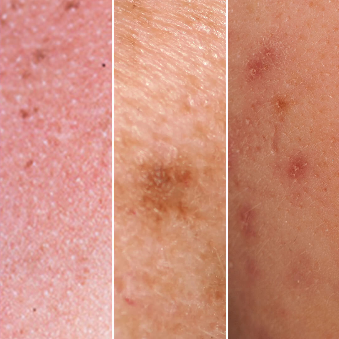 Closeup of three immediate signs of sun damage: sunburn, sun spot, post-inflammatory hyperpigmentation