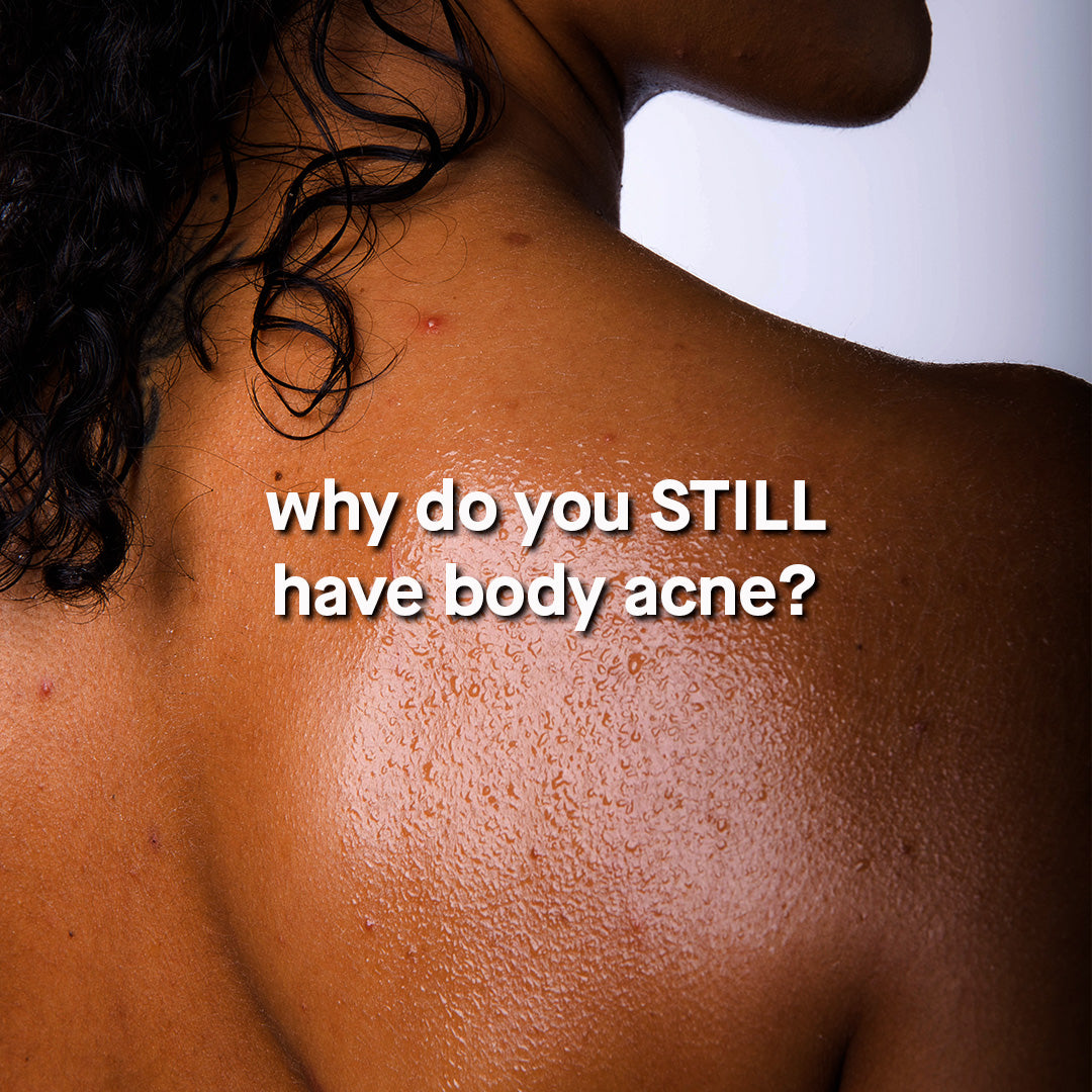 I Shower Every Day. So Why Do I Still Have Body Acne?