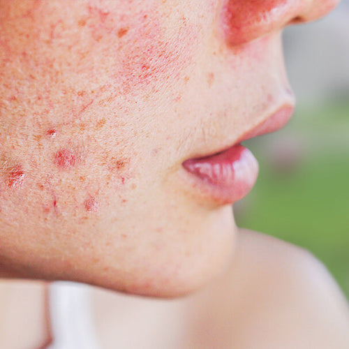 A woman with acne prone skin in springtime