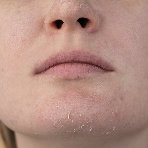 Flaky skin that could use soothing ingredients 