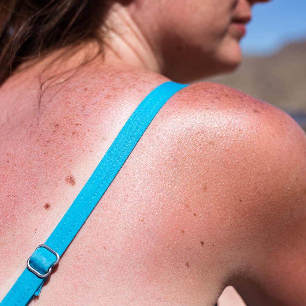 A woman getting sunburned from exposure to UVA and UVB rays