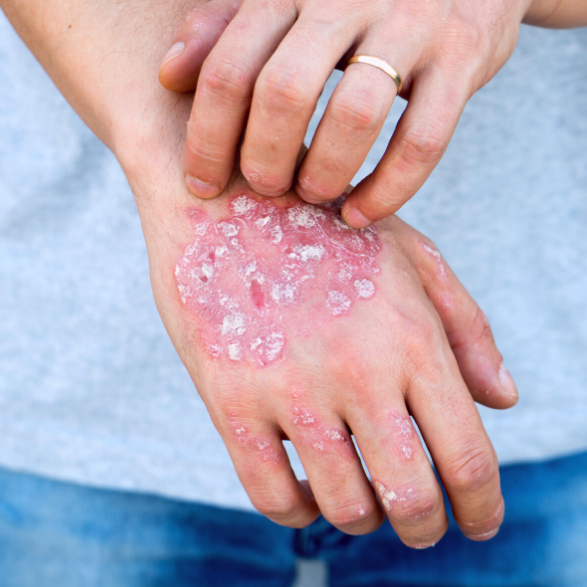 Our Guide to Managing Psoriasis