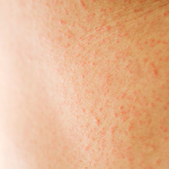 Everything You Need To Know About Contact Dermatitis
