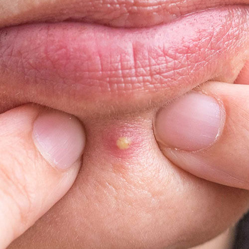 A pimple that's filled with pus and bacteria