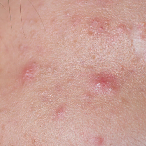 Skin with acne vulgaris