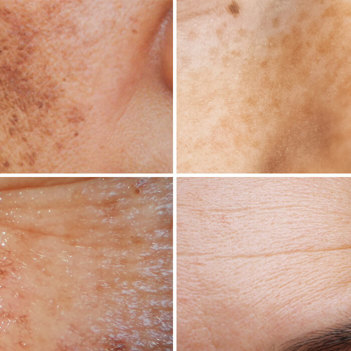 Examples of the first signs of sun damage, including dark marks and wrinkles