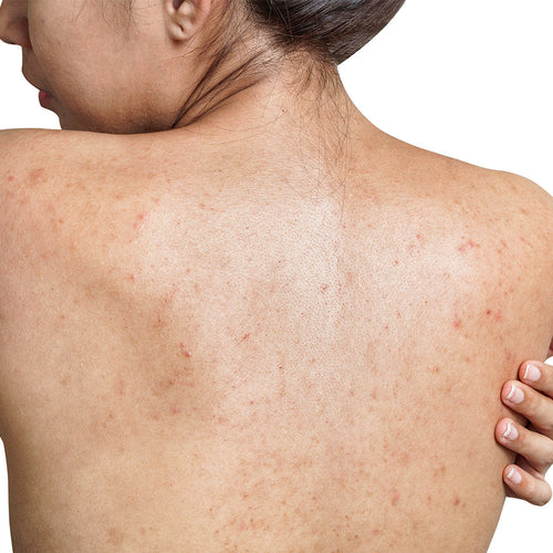 4 Winter Lifestyle Hacks to Keep Body Acne Away