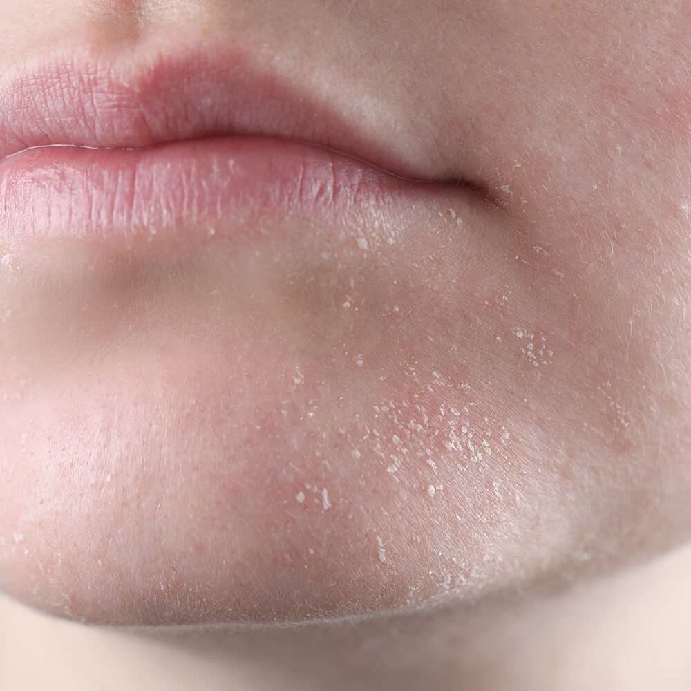 A closeup photo of a woman's face with dry winter skin