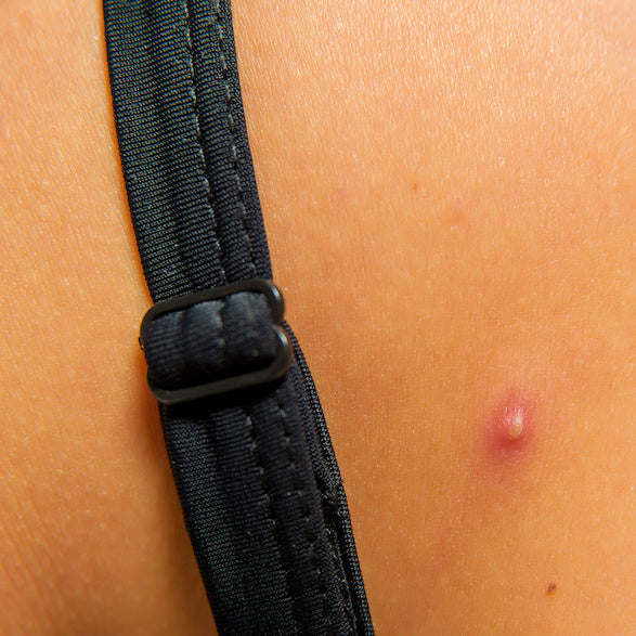 How to Prevent Workout Acne: Dr. Pimple Popper’s Guide – SLMD Skincare ...