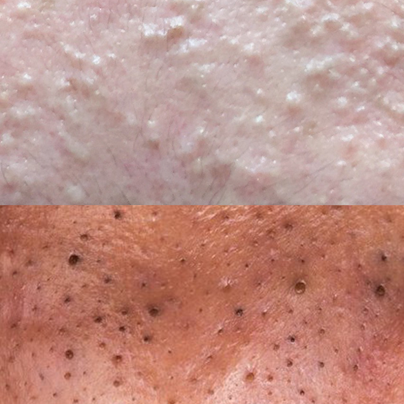 photo of blackheads vs. whiteheads