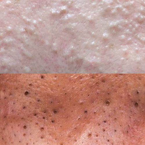 photo of blackheads vs. whiteheads