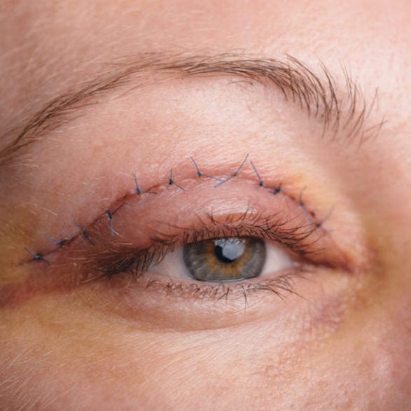 Blepharoplasty Basics: How Eyelid Surgery Works