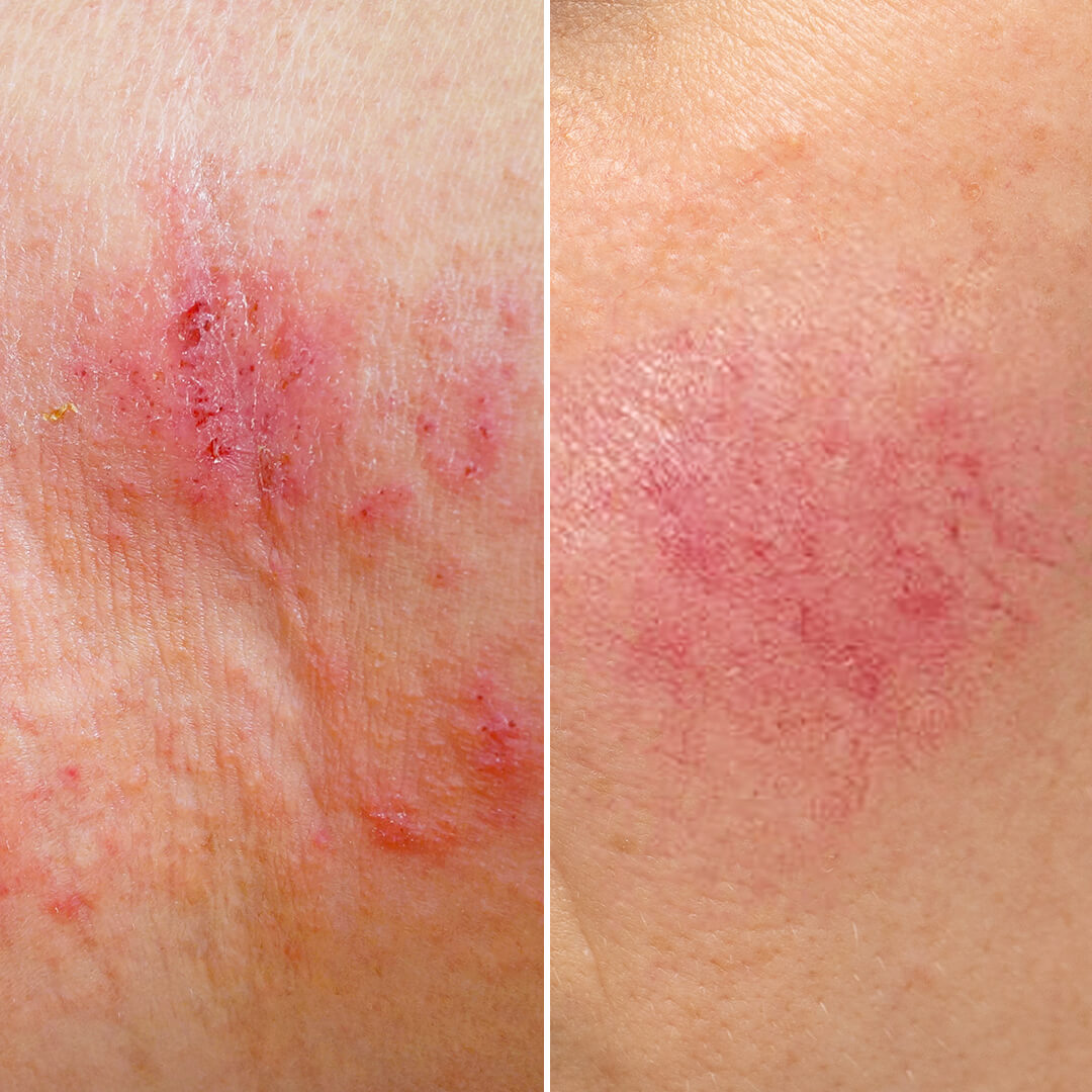 A closeup of the difference between eczema and rosacea