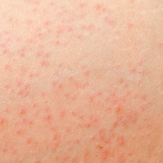 A case of fungal acne, Malassezia folliculitis