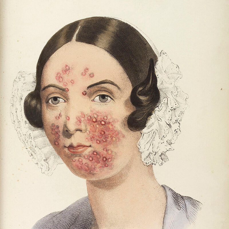 Illustration of a woman from 1800s with facial acne