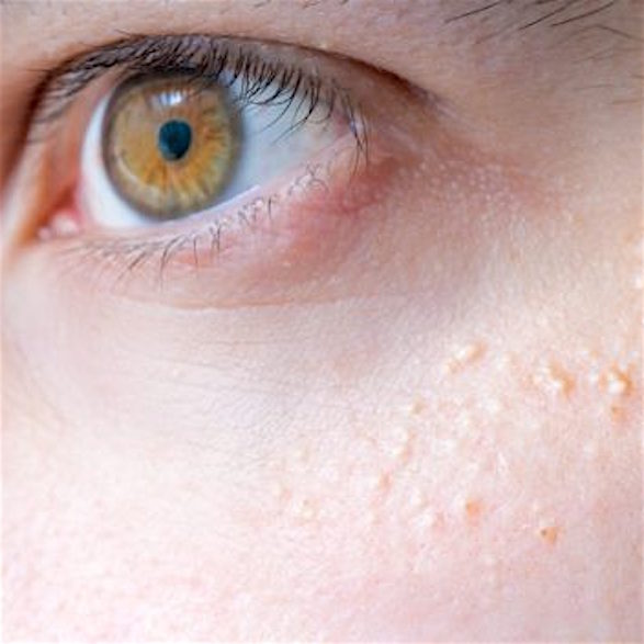 A closeup of the eye area showing milia
