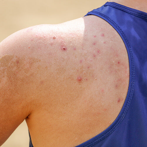 A photo of body acne on the shoulders, best treated with salicylic acid and benzoyl peroxide