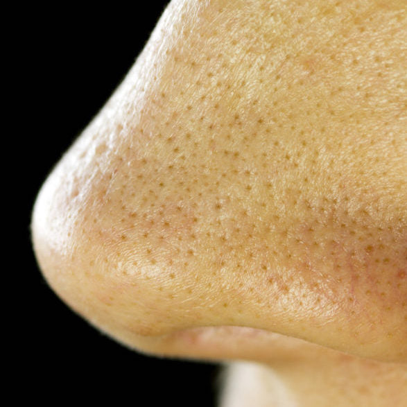 A nose covered in sebaceous filaments not blackheads