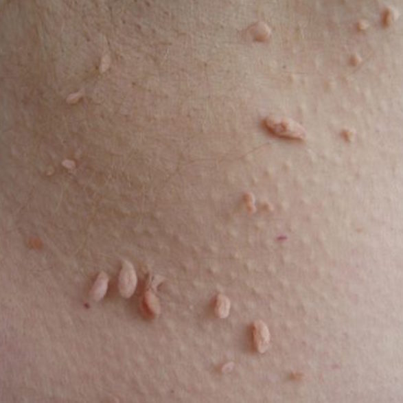 Cutting Ties With Skin Tags