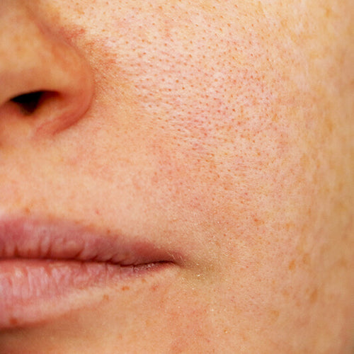 A closeup of a woman with oily or acne prone skin