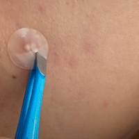 Pimple patch being taken off.