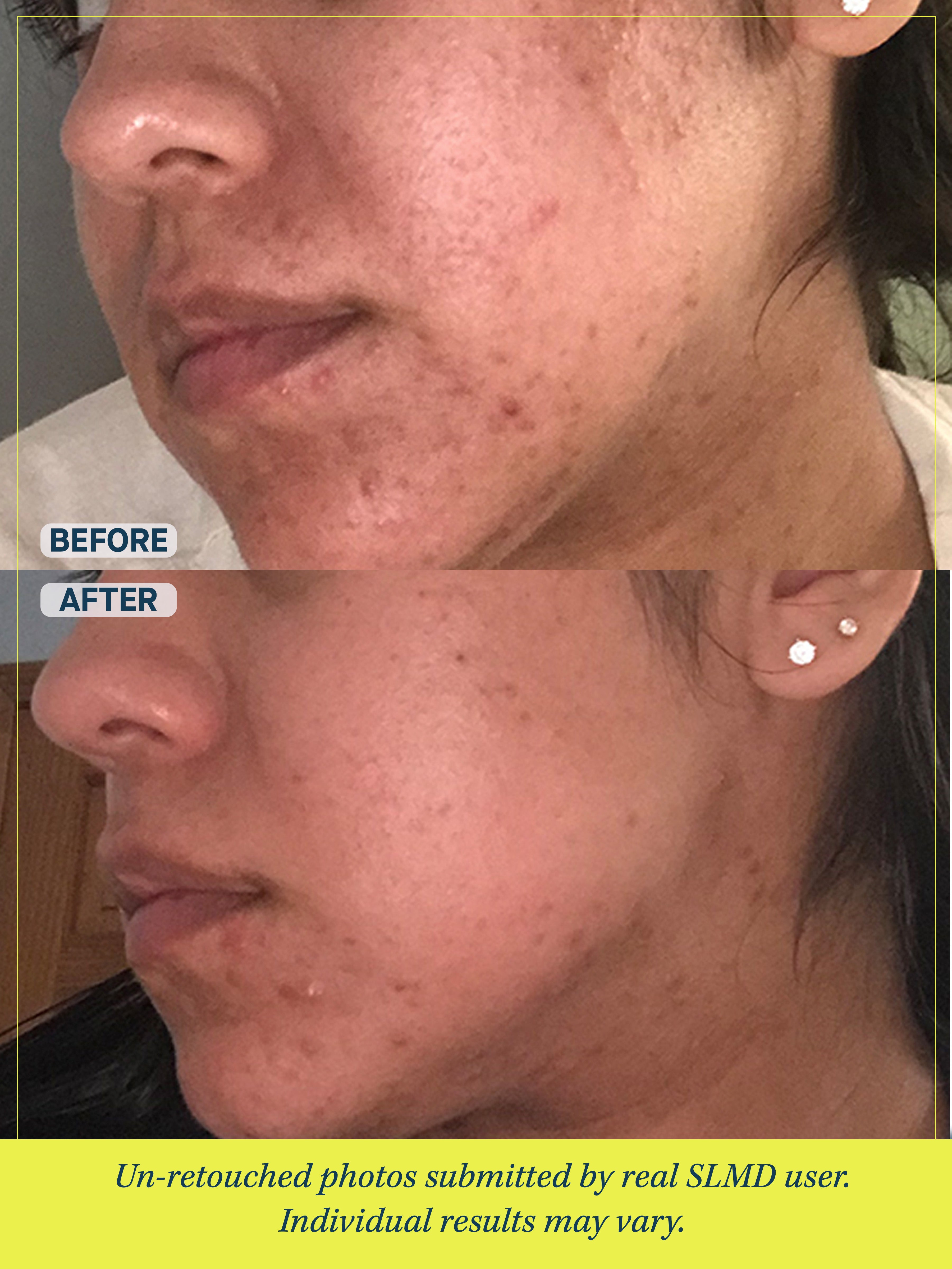 Acne System – SLMD Skincare by Sandra Lee, M.D. - Dr. Pimple Popper