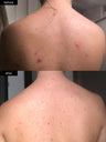 A before and after photograph of bacne clearing up after using SLMD Body Acne System