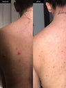 A before and after photograph of back acne clearing up after using SLMD Body Acne System
