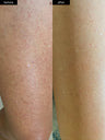 A before and after photo of smoother skin after using SLMD Body Smoothing System for keratosis pilaris