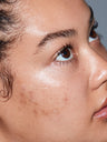 A model applying SLMD Dark Spot fix for hyperpigmentation