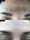 A before and after photograph of hyperpigmentation improving from using SLMD Dark Spot fix