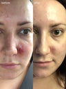 A before and after photo of a woman's acne clearing up after SLMD Sensitive Skin Acne System