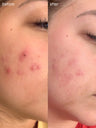 A before and after closeup photo of a woman's acne clearing up from Sensitive Skin Acne System