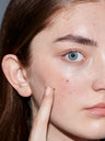 A woman using SLMD Spot Check Acne Patches with salicylic acid